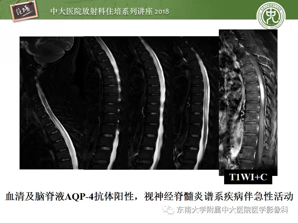 【PPT】脊髓内常见疾病的MR诊断