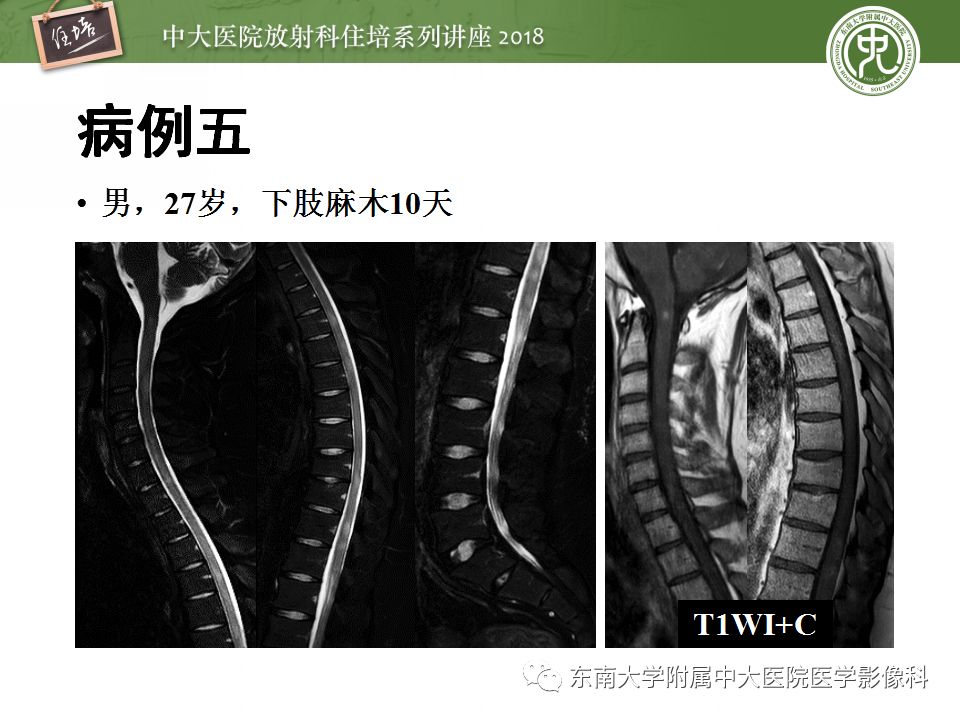 【PPT】脊髓内常见疾病的MR诊断