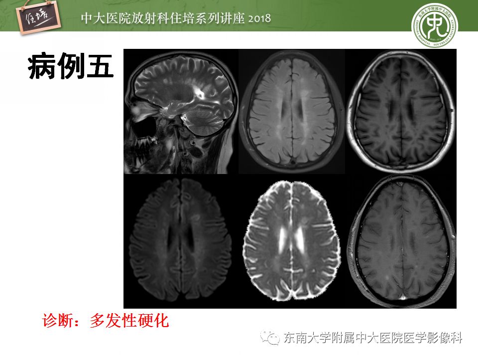 【PPT】脊髓内常见疾病的MR诊断