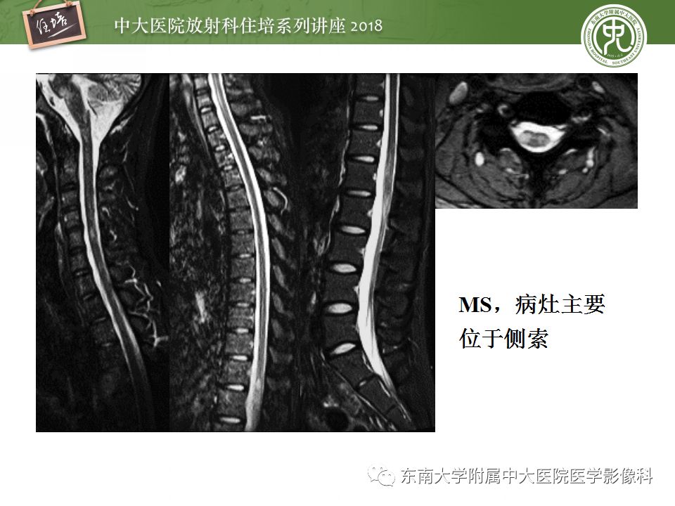 【PPT】脊髓内常见疾病的MR诊断