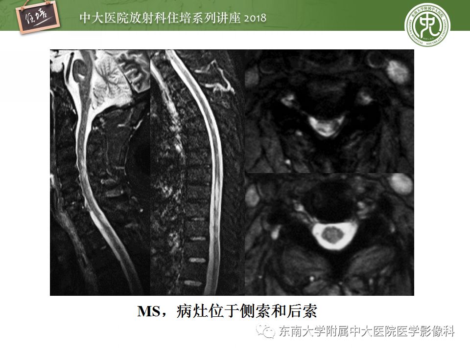 【PPT】脊髓内常见疾病的MR诊断