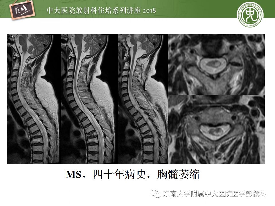 【PPT】脊髓内常见疾病的MR诊断