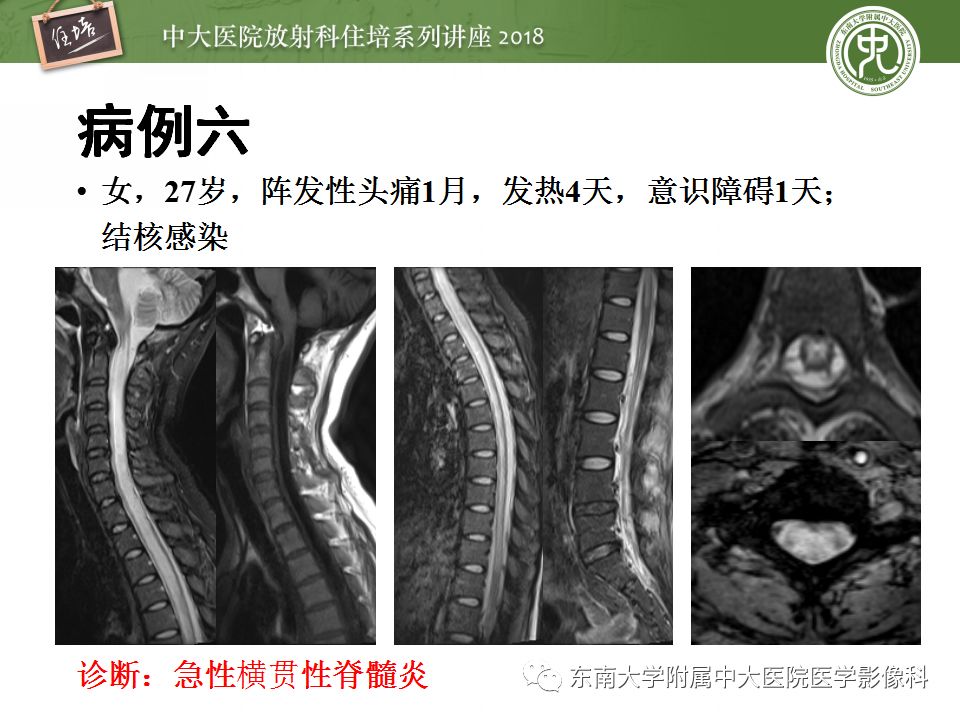 【PPT】脊髓内常见疾病的MR诊断