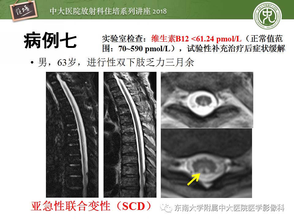 【PPT】脊髓内常见疾病的MR诊断