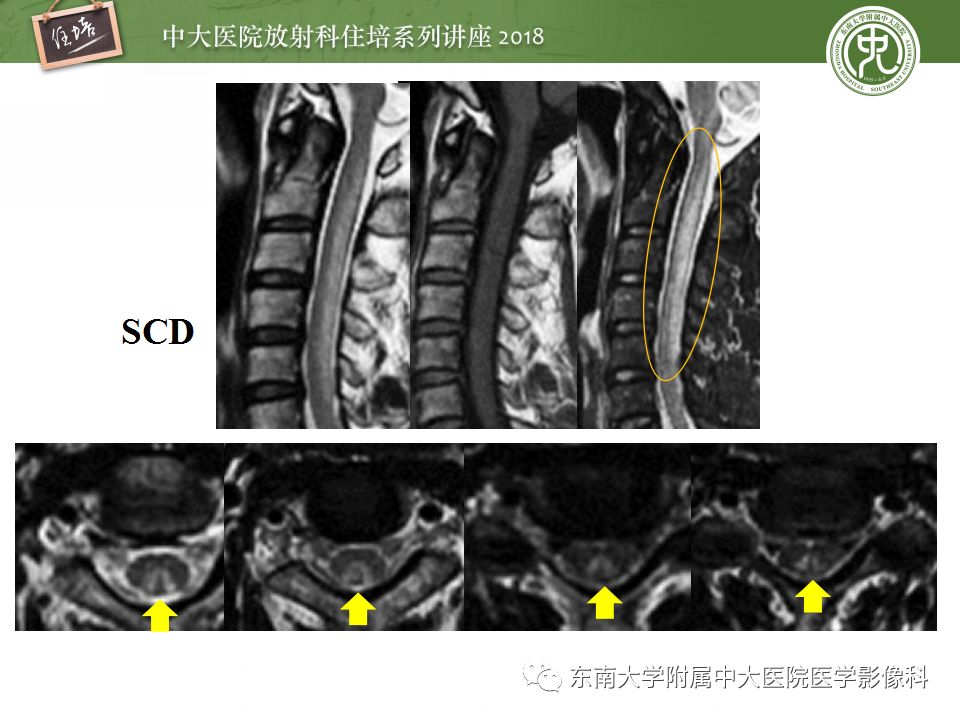 【PPT】脊髓内常见疾病的MR诊断