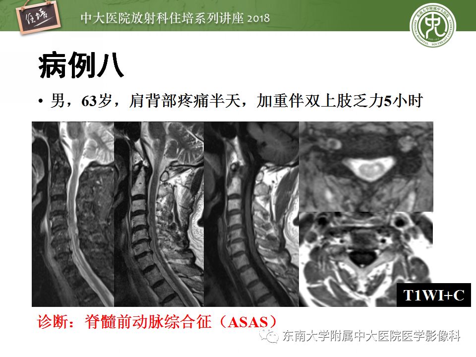【PPT】脊髓内常见疾病的MR诊断