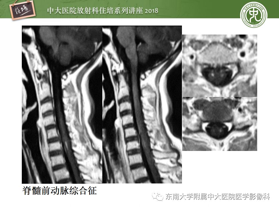 【PPT】脊髓内常见疾病的MR诊断