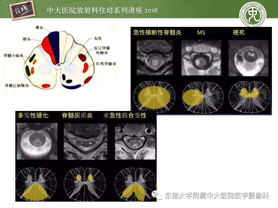 【PPT】脊髓内常见疾病的MR诊断