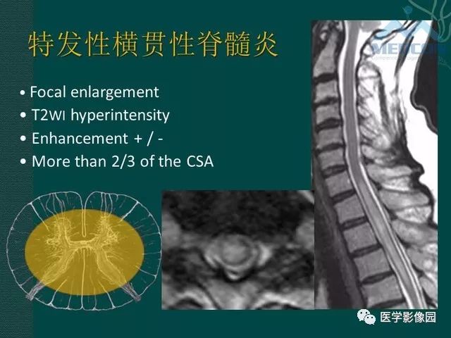 【PPT】脊髓急性炎性病变的影像诊断与鉴别诊断