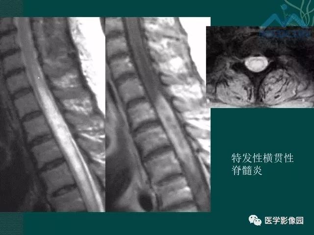 【PPT】脊髓急性炎性病变的影像诊断与鉴别诊断