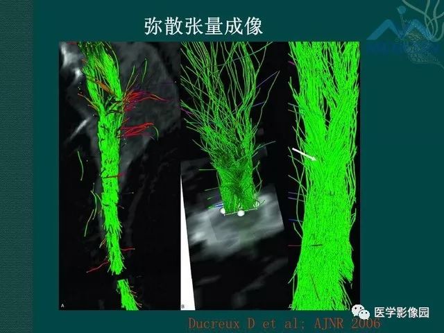 【PPT】脊髓急性炎性病变的影像诊断与鉴别诊断