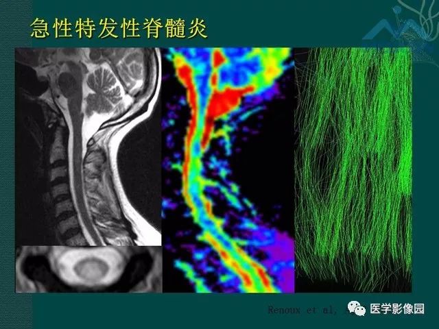 【PPT】脊髓急性炎性病变的影像诊断与鉴别诊断