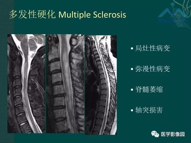 【PPT】脊髓急性炎性病变的影像诊断与鉴别诊断