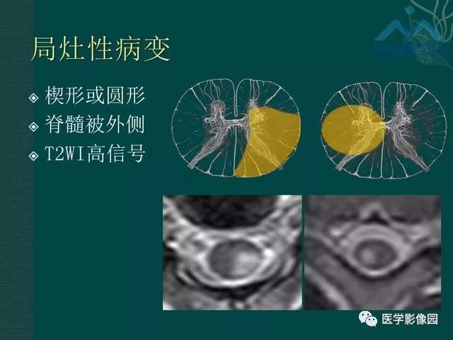 【PPT】脊髓急性炎性病变的影像诊断与鉴别诊断