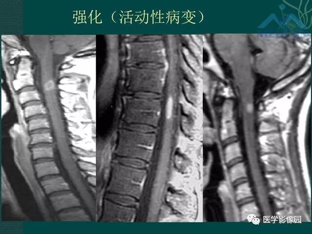 【PPT】脊髓急性炎性病变的影像诊断与鉴别诊断