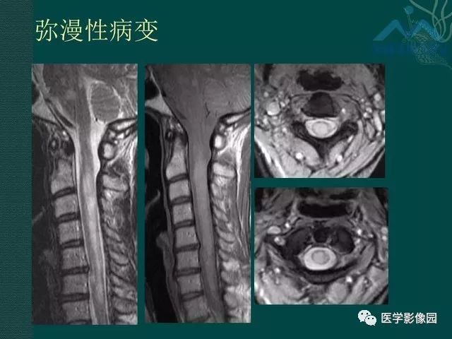 【PPT】脊髓急性炎性病变的影像诊断与鉴别诊断