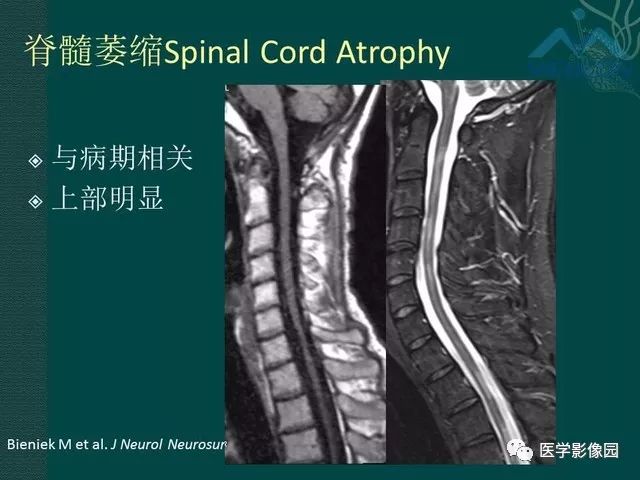 【PPT】脊髓急性炎性病变的影像诊断与鉴别诊断