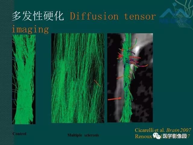 【PPT】脊髓急性炎性病变的影像诊断与鉴别诊断