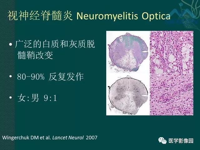 【PPT】脊髓急性炎性病变的影像诊断与鉴别诊断