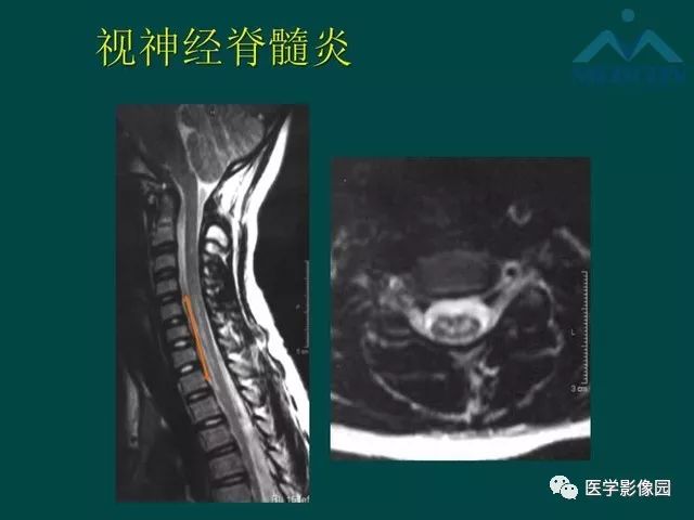 【PPT】脊髓急性炎性病变的影像诊断与鉴别诊断