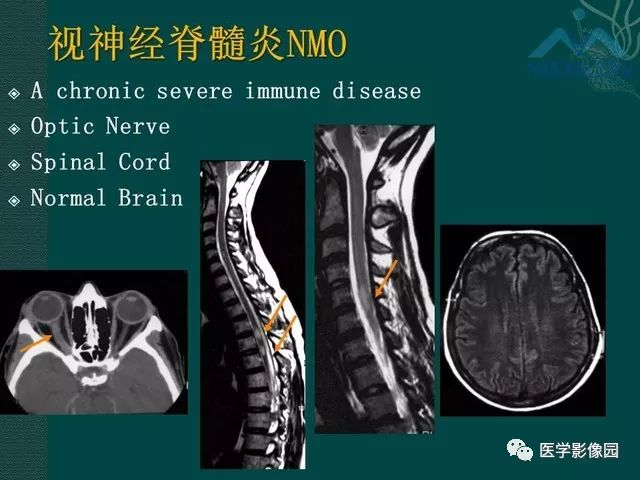 【PPT】脊髓急性炎性病变的影像诊断与鉴别诊断