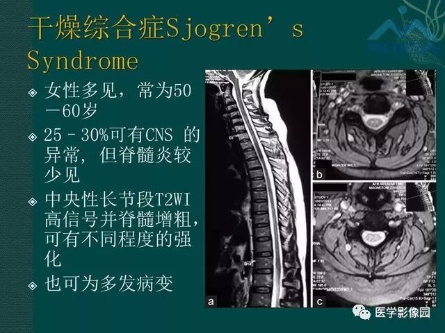 【PPT】脊髓急性炎性病变的影像诊断与鉴别诊断