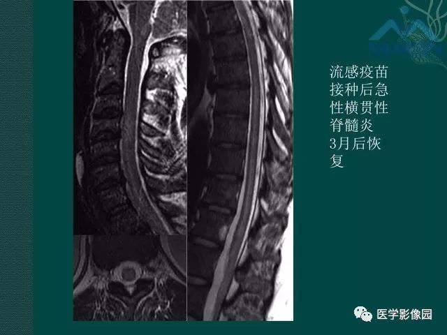 【PPT】脊髓急性炎性病变的影像诊断与鉴别诊断