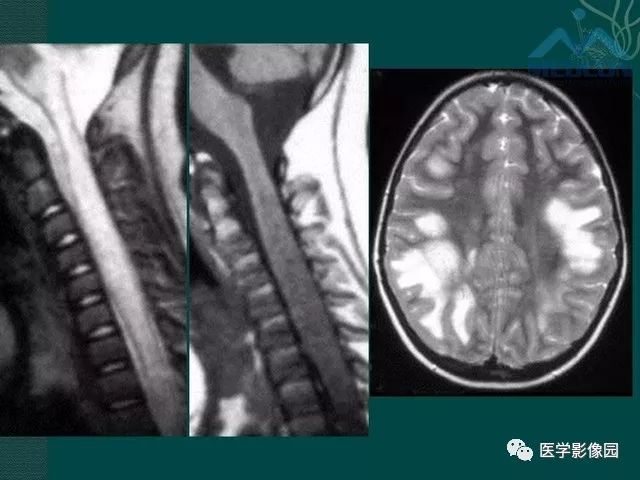【PPT】脊髓急性炎性病变的影像诊断与鉴别诊断