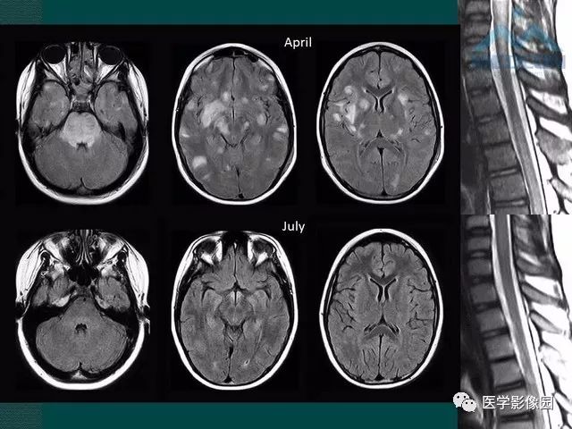 【PPT】脊髓急性炎性病变的影像诊断与鉴别诊断