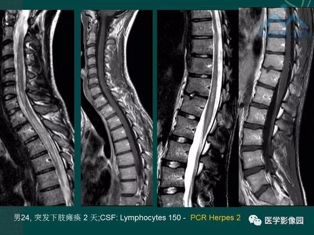 【PPT】脊髓急性炎性病变的影像诊断与鉴别诊断