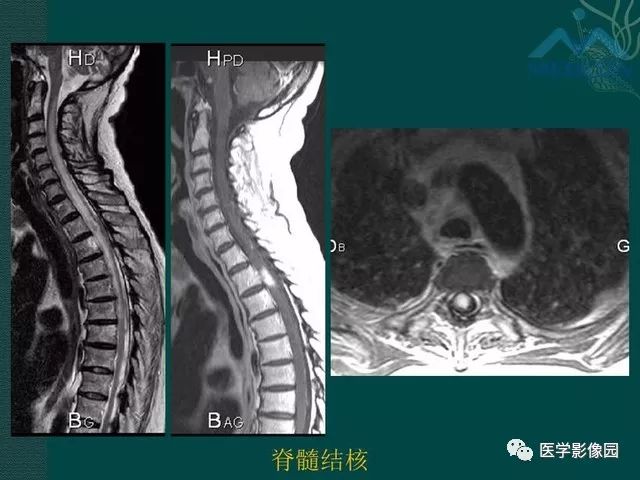 【PPT】脊髓急性炎性病变的影像诊断与鉴别诊断