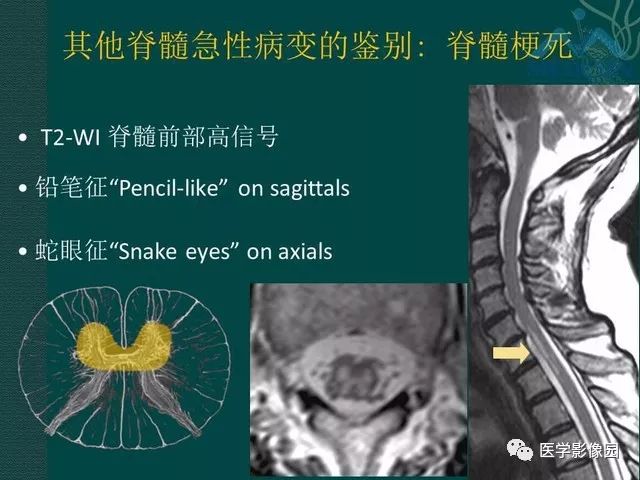 【PPT】脊髓急性炎性病变的影像诊断与鉴别诊断