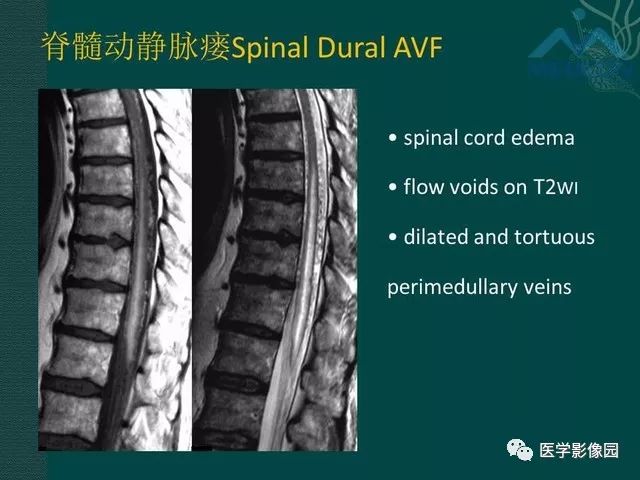 【PPT】脊髓急性炎性病变的影像诊断与鉴别诊断
