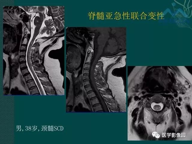 【PPT】脊髓急性炎性病变的影像诊断与鉴别诊断