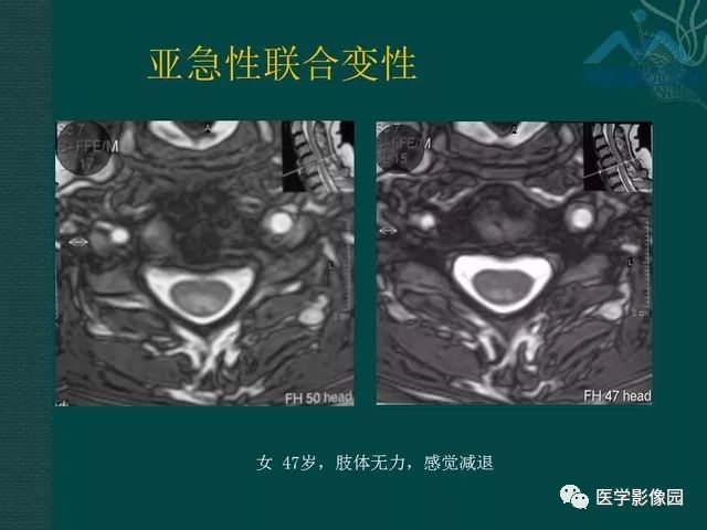 【PPT】脊髓急性炎性病变的影像诊断与鉴别诊断