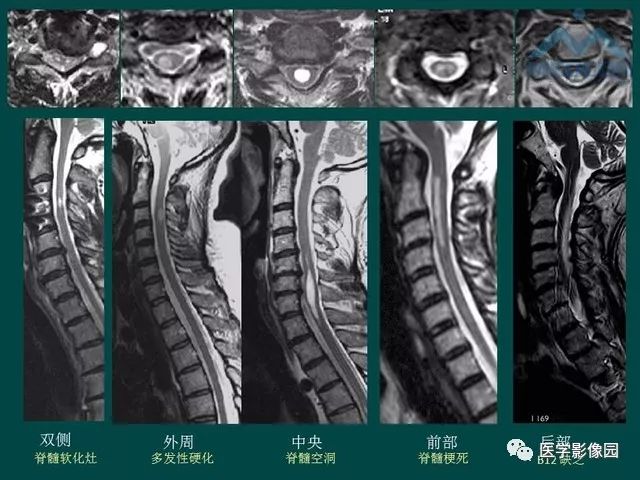 【PPT】脊髓急性炎性病变的影像诊断与鉴别诊断
