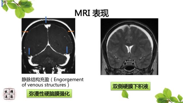【病例】低颅压综合症1例MR影像表现