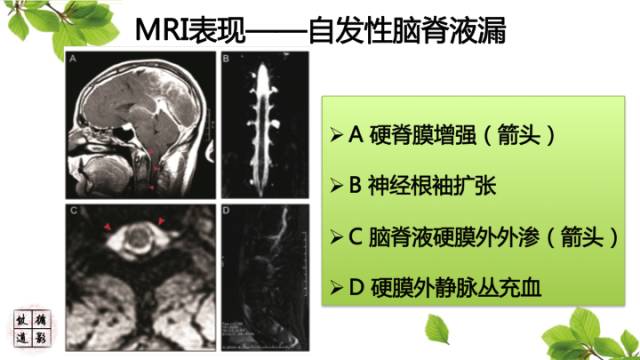 【病例】低颅压综合症1例MR影像表现