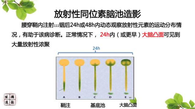【病例】低颅压综合症1例MR影像表现