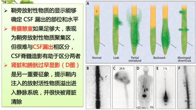 【病例】低颅压综合症1例MR影像表现