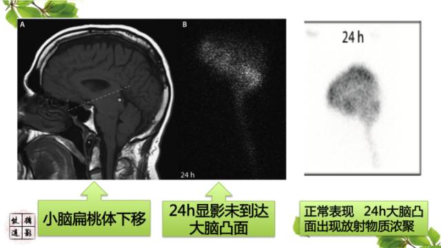 【病例】低颅压综合症1例MR影像表现