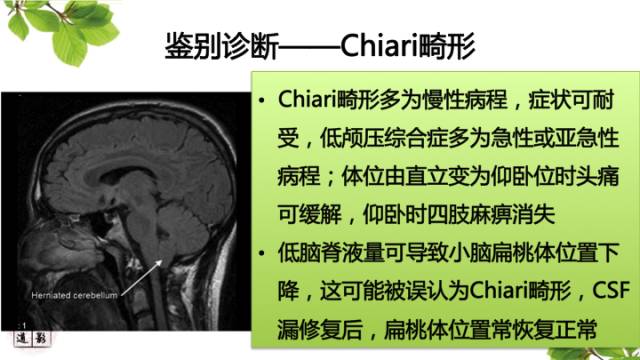 【病例】低颅压综合症1例MR影像表现