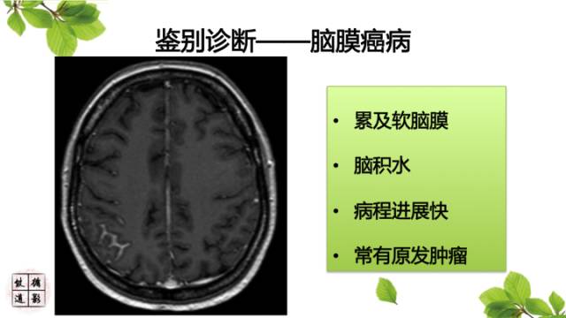【病例】低颅压综合症1例MR影像表现