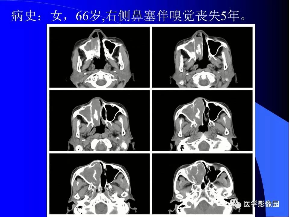 【病例】鼻腔内翻型乳头状瘤1例CT及MR影像诊断
