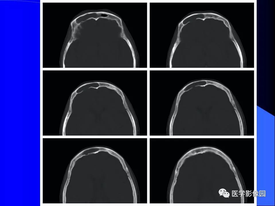 【病例】鼻腔内翻型乳头状瘤1例CT及MR影像诊断