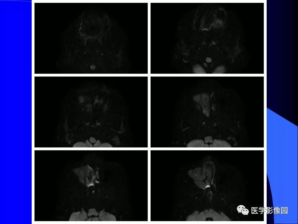 【病例】鼻腔内翻型乳头状瘤1例CT及MR影像诊断