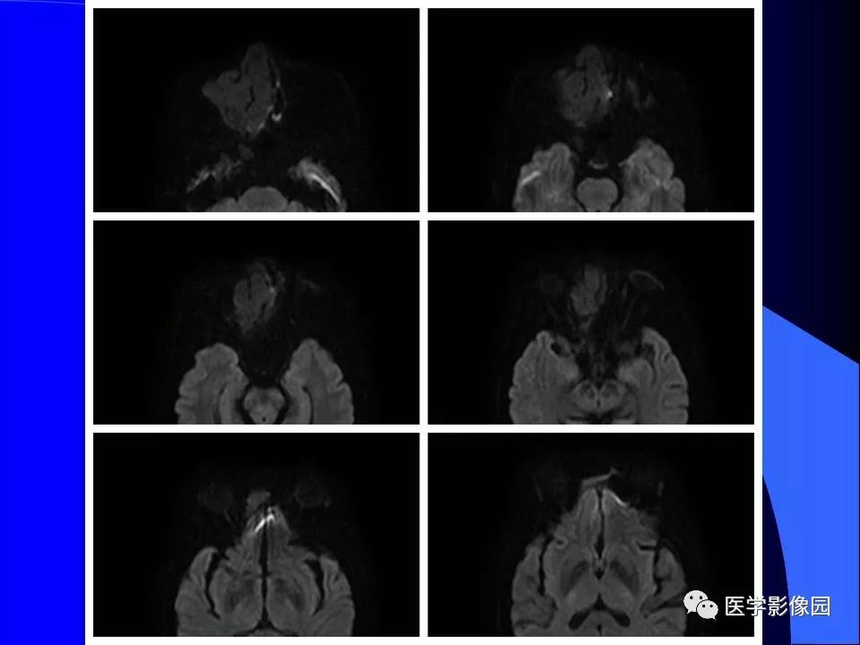 【病例】鼻腔内翻型乳头状瘤1例CT及MR影像诊断