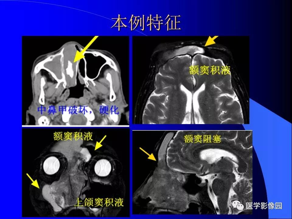 【病例】鼻腔内翻型乳头状瘤1例CT及MR影像诊断