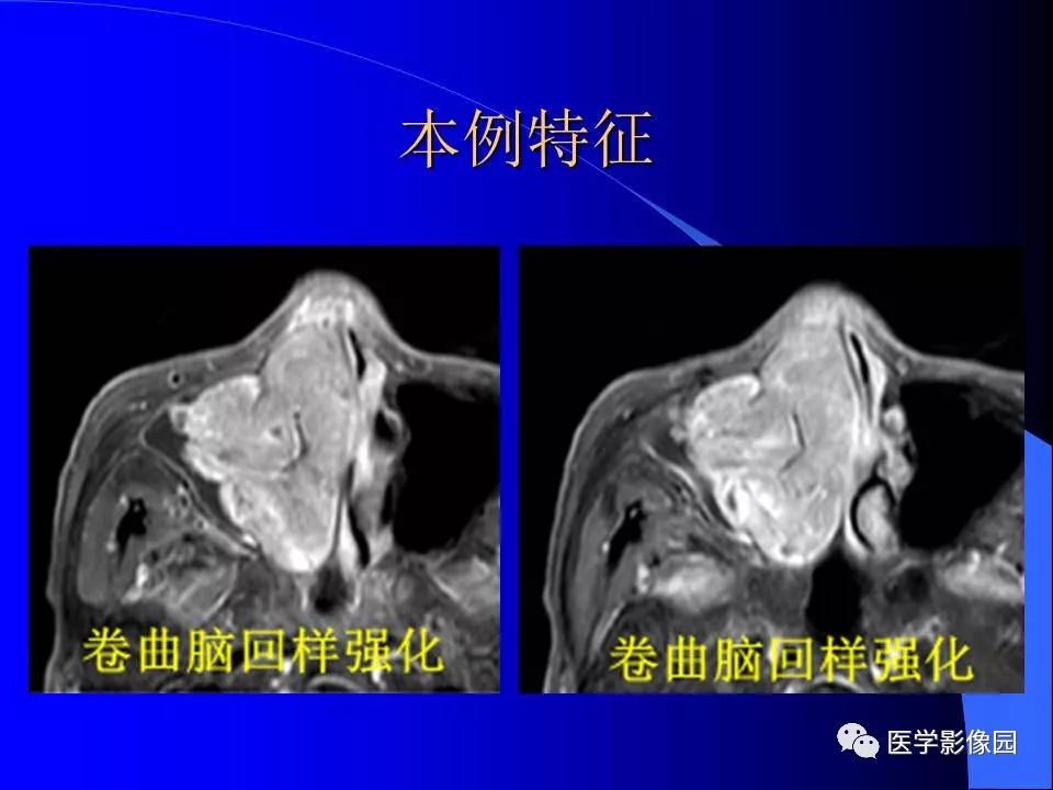【病例】鼻腔内翻型乳头状瘤1例CT及MR影像诊断