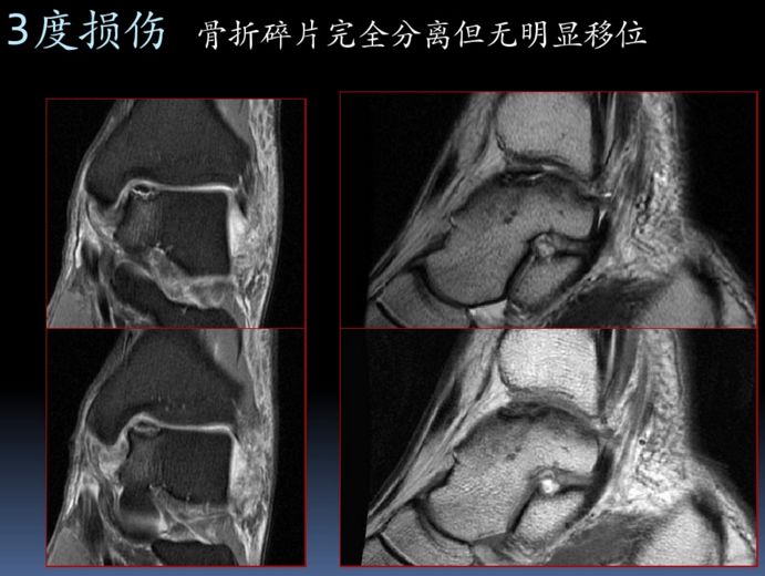 踝关节常见病变的MRI表现 踝关节常见病变的MRI表现